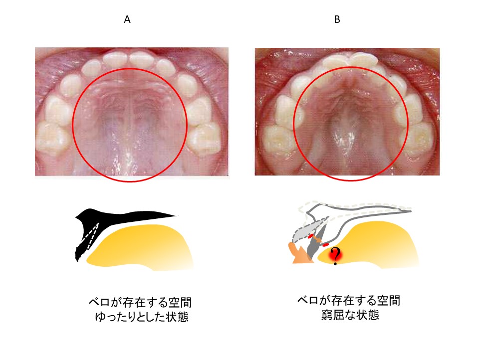 舌小帯 上唇小帯について 小児歯科 小児矯正のひかり歯科医院